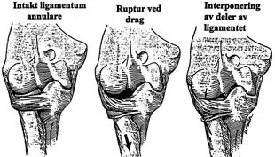  Figur 1    Patologisk anatomi vedsubluksasjon av radiushodet. Ligamentum annulare omslutter caput radii ogfester radius til&hellip;