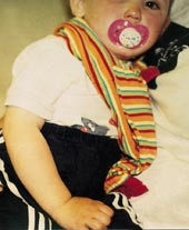  Figur 2    27 m&aring;neder gammel jente med h&oslash;yresidig subluksasjon avradiushodet. Armen er lett flektert i albuen og&hellip;