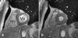 Figur 2    Kortakse cine-MR av venstre ventrikkel i a) endediastole og b) endesystole. Opptakstiden var ca. 15 s (holdpusten&hellip;