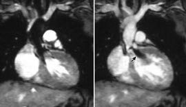 Figur 3    Valvul&aelig;r aortastenose (gradient 70 mm Hg) og liten aortainsuffisiens hos 17 &aring;r gammel kvinne vist med&hellip;