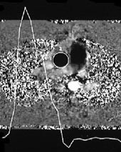 Figur 4    Fasekontrast cine-MR med blodstr&oslash;msm&aring;ling i aorta ascendens. Fasekontrastbildet er et aksialsnitt gjennom thorax&hellip;
