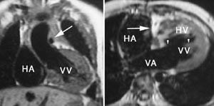 Figur 5    Trikuspidalatresi og hypoplastisk pulmonalarterie hos tre &aring;r gammel gutt.  a) Frontalsnitt viser sterkt&hellip;