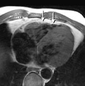 Figur 8    H&oslash;yre ventrikkel-dysplasi hos 39 &aring;r gammel mann. Det er fettinfiltrasjon og kraftig fortynning i deler av h&oslash;yre&hellip;
