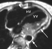 Figur 9    Angiomyosarkom i venstre ventrikkel (VV) hos 61 &aring;r gammel kvinne. Aksialt T1-vektet bilde viser at tumor (T) har&hellip;