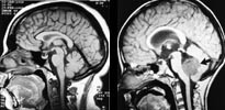 Figur 2    a) T1-vektet midtlinjesnitt av 15 &aring;r gammel normal gutt.  b) Seks &aring;r gammel gutt med medulloblastom i bakre&hellip;