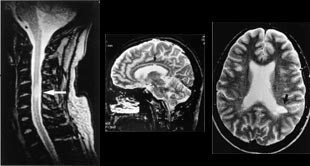Figur 5    50 &aring;r gammel mann med multippel sklerose.  a) Sagittalt T2-vektet bilde viser stort plakk med h&oslash;yt signal i&hellip;