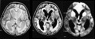 Figur 9    Tre &aring;r gammel gutt innlagt med streptokokkmeningitt.  a) Protontetthetsbilder og  b) bilder tatt med s&aring;kalt FLAIR&hellip;