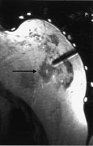 Figur 3    MR-veiledet finn&aring;lsaspirasjon av brysttumor med 22 gg titann&aring;l. Pilen peker p&aring; tumor. P&aring; hudoverflaten sees&hellip;