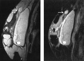 Figur 5    Silikonlokulamenter i vevet kan differensieres fra andre strukturer som kjertelvev og fettvev ved &aring; kombinere&hellip;