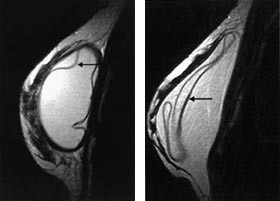 Figur 8    T2-vektede bilder i sagittalplan av intrakapsul&aelig;re rupturer.  a) Begynnende ruptur. Pilen peker p&aring; silikonskallet&hellip;