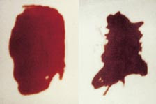  Figur 4    Blod som inneholder mer enn 10 &ndash; 15 % methemoglobin (pasient 1, til h&oslash;yre) vil v&aelig;re klart brunere enn&hellip;