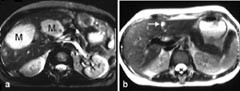Figur 2    T2-vektede MR-opptak av lever med gammel og ny teknikk.  a) Lever med metastaser (M), konvensjonell&hellip;