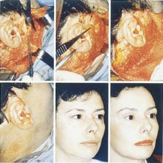 Noen pasienter er til forveksling like vakre f&oslash;r og etter kosmetiske inngrep. Bildet er fra Plastic and reconstructive&hellip;