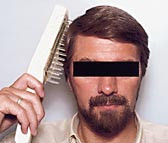  Figur 1    Behandling med UV-B-kam hos pasient med hodebunnspsoriasis. Gjengitt med pasientens tillatelse. Foto Trond-Roar&hellip;