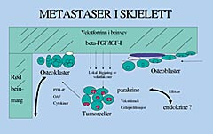  Figur 1    Skjelettmetastaser og lokale vekstfortrinn i beinvev
