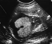 Figur 1    Ultralydbilde av foster med forst&oslash;rret lever og ascites