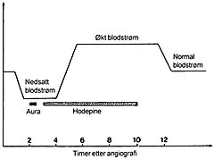  Figur 1   Blodstr&oslash;m i hjernen under migreneanfall med aura. Diagram som viser endringer i regional cerebral blodstr&oslash;m i&hellip;