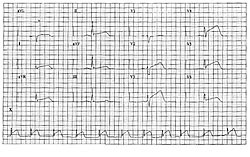  Figur 1    Faksimile av et 12-kanals EKG overf&oslash;rt fra ambulanse til sykehus. Papirhastighet: 50 mm/s