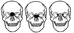 Figur 2    Frontoetmoidale meningoencefaloceler inndeles i tre subtyper, avhengig av den ytre beinete defekt. a) Ved den&hellip;