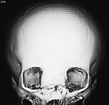  Figur 3    CT ansiktsskjelett med tredimensjonal rekonstruksjon som illustrerer de brede, misdannede nesebeina som man&hellip;