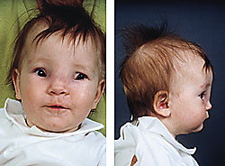  Figur 4    Pasient 2, en seks m&aring;neder gammel pike som fra f&oslash;dselen av hadde en hevelse over neseroten, spesielt mot h&oslash;yre&hellip;