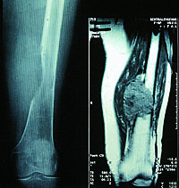  Figur 2    Osteolytisk metastase til humerus med stor bl&oslash;tdelskomponent