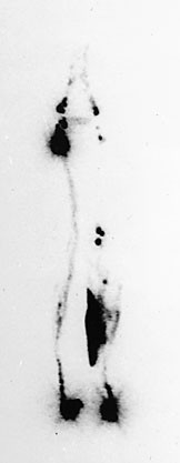  Figur 2    Tidligere skade av venstre kne og l&aring;r, med utvikling av lymf&oslash;dem. Opptak 160 minutter etter injeksjon. &laquo;Lymfesj&oslash;&hellip;