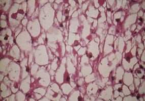  Figur 1    Mikroskopisk snitt av myksom med sm&aring; cellekjerner spredt i et stroma med bindevev og glykogenvakuoler