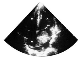  Figur 3    Ekkokardiografisk foto av myksom i venstre atrium (LA). Svulsten er smalstilket og pendulerende