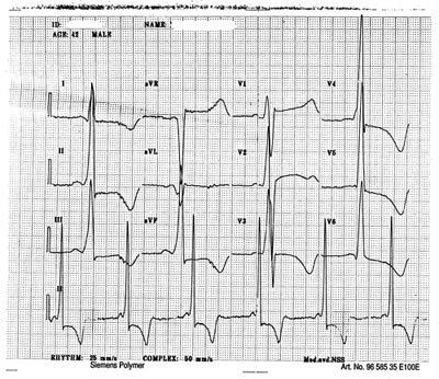  Figur 1    EKG fra pasient 1. Legg merke til kort PQ-tid og tegn til venstre ventrikkelhypertrofi med sekund&aelig;re&hellip;