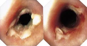  Figur 1    a) Velavgrenset sirkul&aelig;r lesjon distalt i oesophagus, kledd med et hvitaktig belegg.  b) Samme lesjon etter&hellip;