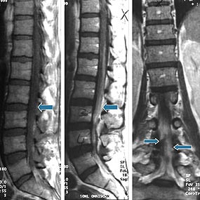 Figur 1    MR-unders&oslash;kelse fra dag 56 (pasient 5) viser a) generelt &oslash;kt signal i spinalv&aelig;sken p&aring; sagittalt T1-vektet bilde,&hellip;