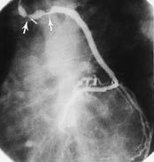  Figur 2    Koronarangiografi av pasient 2. Fremre venstre skr&aring;projeksjon med kontrastinjeksjon i aortokoronar venebypass&hellip;