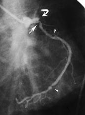  Figur 3    Koronarangiografi av pasient 3. Fremre venstre skr&aring;projeksjon med kontrastinjeksjon i venstre koronararterie&hellip;
