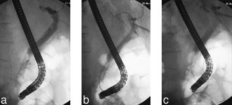  Figur 1    Okkludert wallstent p&aring; grunn av tumorinnvekst og innleggelse av plaststent i wallstent.  a) Kontrastdefekt i&hellip;