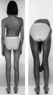 Figur 1  Patient med skoliose, hvor torsionsprominensen accentueres ved foroverb&oslash;jning