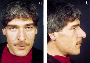  Figur 1    Diskr&eacute;, men typiske trekk hos nydiagnostisert 42-&aring;rig mann med akromegali. Bildene er gjengitt med pasientens&hellip;