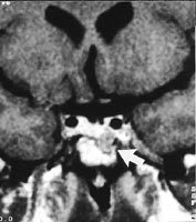  Figur 3    Koronalt T1-vektet MR-bilde etter kontrast viser normal oppladning i hypofyse og nedre del av hypofysestilken&hellip;