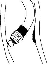  Figur 3    En strikk er festet rundt basis av en varix. Fire strikker er oppspent p&aring; plastsylinderen p&aring; skoptuppen&hellip;