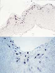  Figur 2a og b    Portiobiopsi med h&oslash;ygradig cervikal intraepitelial neoplasi positiv for HPV-type 16/18 p&aring;vist med in situ&hellip;