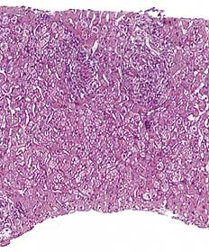  Figur 1    Histologisk snitt av leverbiopsi fra pasient 1 viser akutt og kronisk betennelse med granulomer
