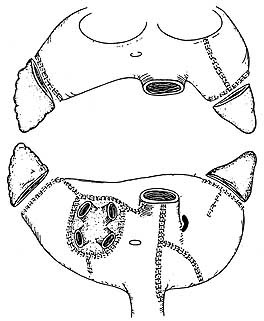  Figur 1    Forenklet fremstilling av h&oslash;yre og venstre atrium sett henholdsvis bakfra (nederst) og forfra (&oslash;verst), med&hellip;