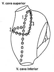  Figur 2    Skjematisk tegning av h&oslash;yre atrium med de tre ablasjonslinjene baktil, 1, horisontalt lateralt, 2, og fortil, 3,&hellip;