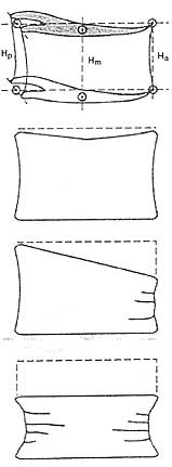  Figur 1    Normal ryggvirvel, og skjematisk tegning av de tre typene vertebrale frakturer: nedpresningsfraktur, kilefraktur&hellip;
