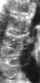  Figur 2    Sterkt osteoporotisk rygg med flere kompresjonsfrakturer. Bildet illustrerer ulik grad av deformitet i&hellip;