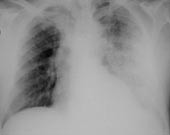  Figur 2    Nytt r&oslash;ntgen thorax etter tre dager med penicillinbehandling. Betydelig progrediering av venstresidige&hellip;