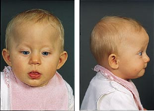  Figur 1    Pasient 1 var en &aring;tte m&aring;neder gammel pike som fra f&oslash;dselen av hadde tilspisset panne, men ellers fin klinisk&hellip;