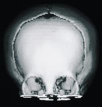  Figur 2    CT Ansiktsskjelett med tredimensjonal rekonstruksjon som illustrerer stigmata som man finner ved trigonocefali