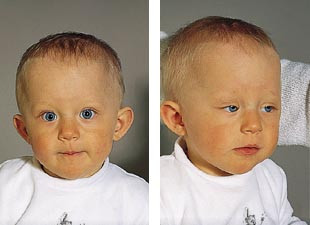  Figur 3    Pasient 1 tre m&aring;neder etter operasjon