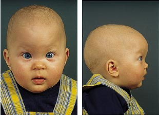  Figur 4    Pasient 2 var en sju m&aring;neder gammel pike som fra tom&aring;nedersalderen hadde noe p&aring;fallende hodefasong. Unders&oslash;kt&hellip;